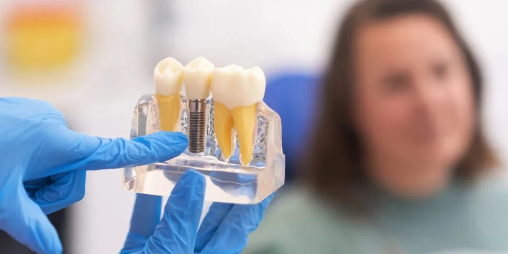 Dental Implants - Smilodon Dental + Implants - Nashville