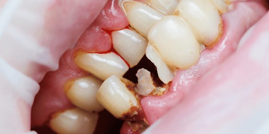 Poor oral health