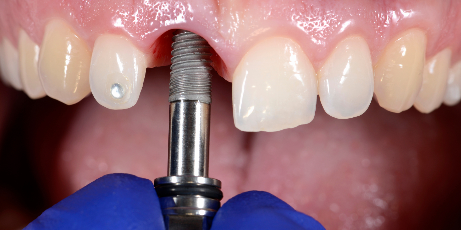 Smilodon Dental + Implants - Implants
