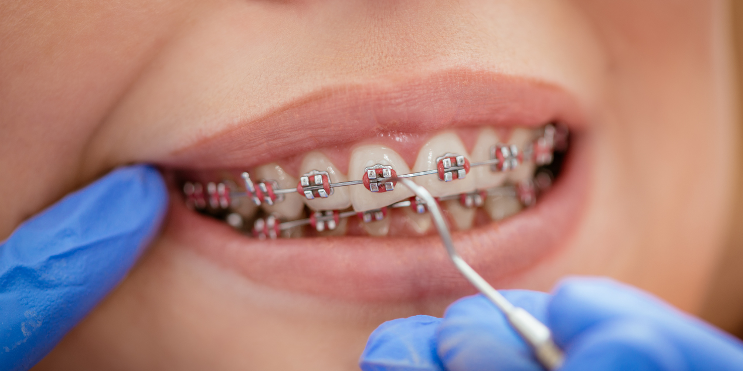 Smilodon Dental + Implants - Braces