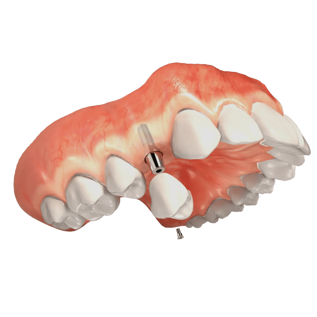 Dental Device - Smilodon Dental + Implants - Nashville