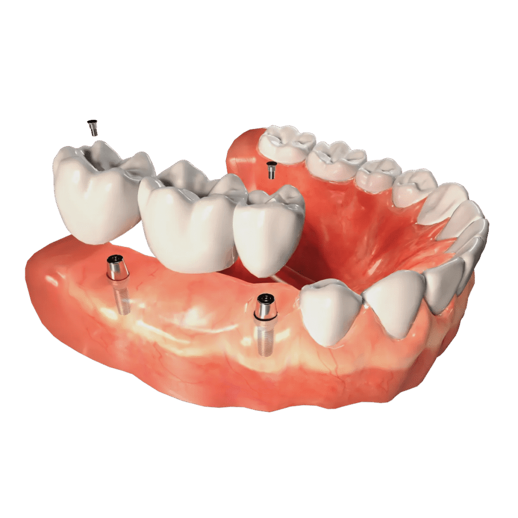 Dental Device - Smilodon Dental + Implants - Nashville