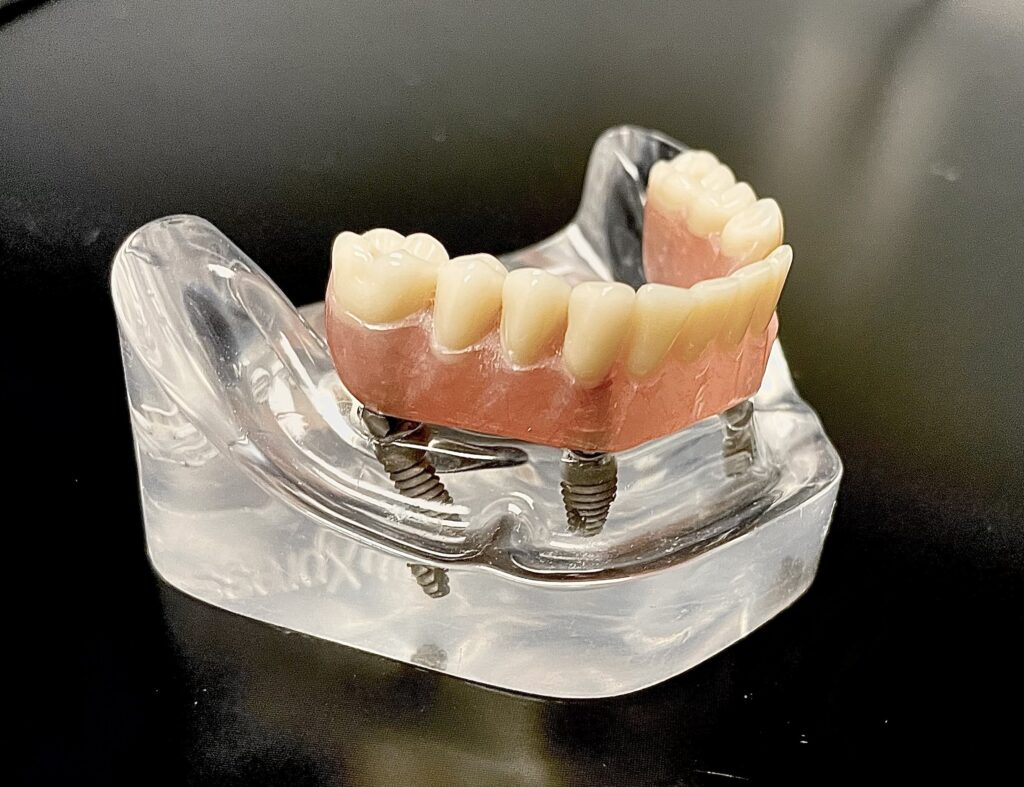 Smilodon Dental + Implants - Dental Device