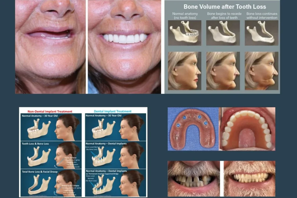 Dental Implant Treatment Photos - Smilodon Dental + Implants - Nashville