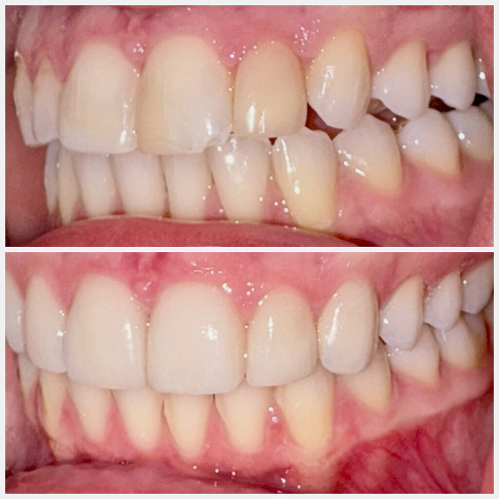 Before and After Teeth Photo - Smilodon Dental + Implants - Nashville