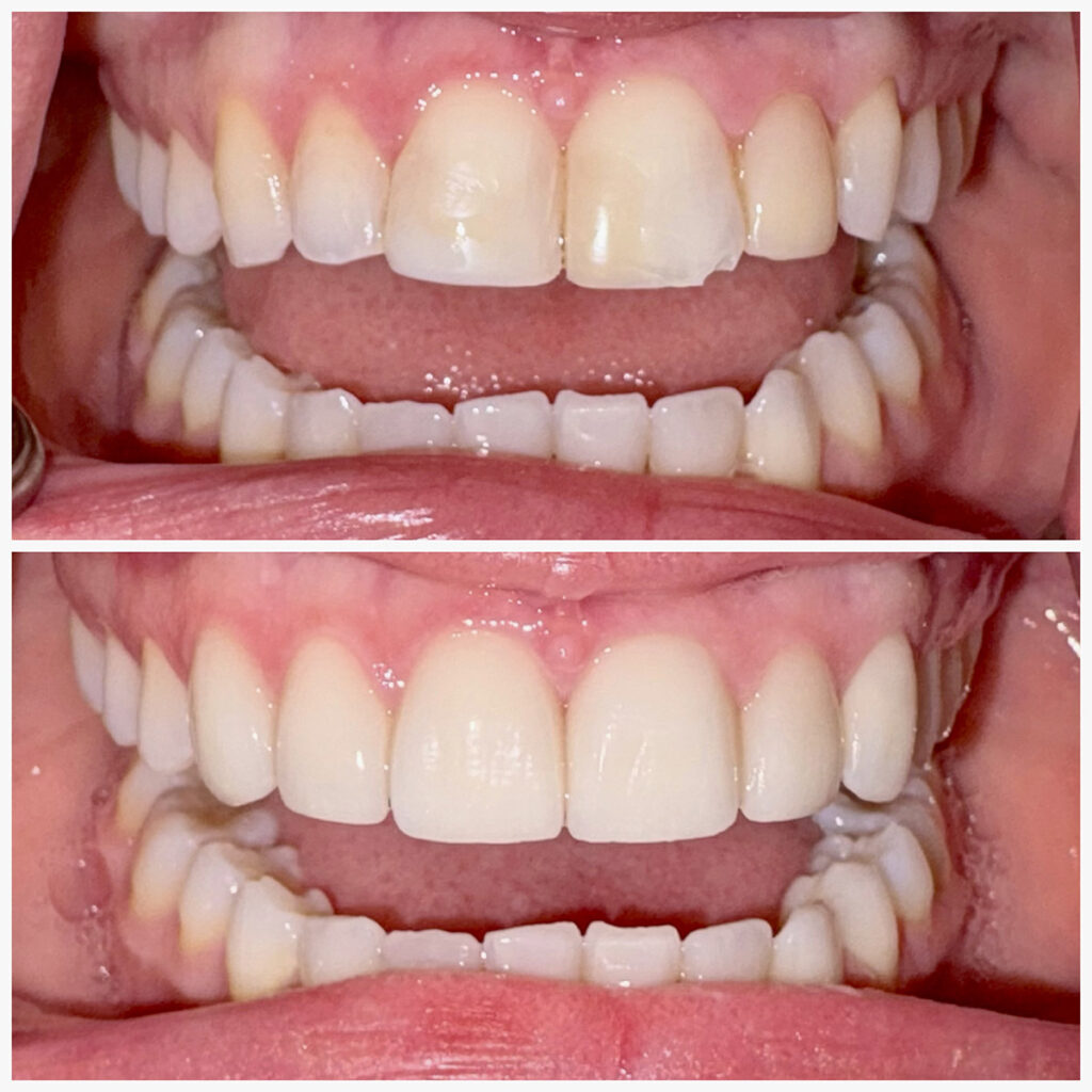 Before and After Teeth Photo - Smilodon Dental + Implants - Nashville