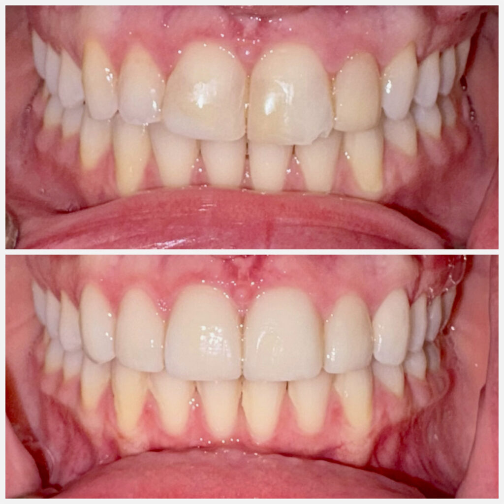 Before and After Teeth Photo - Smilodon Dental + Implants - Nashville