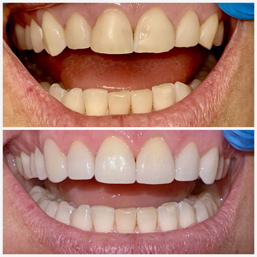 Before and After Teeth Photo - Smilodon Dental + Implants - Nashville