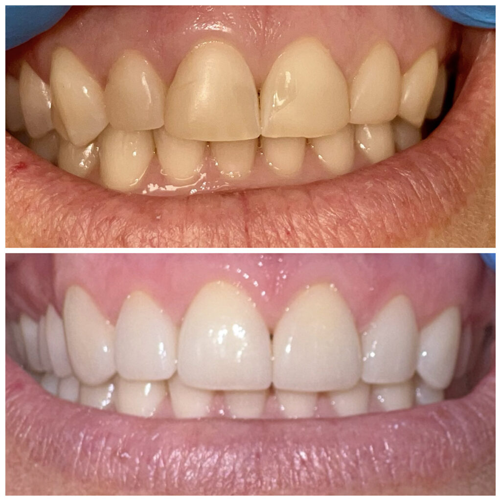 Before and After Teeth Photo - Smilodon Dental + Implants - Nashville