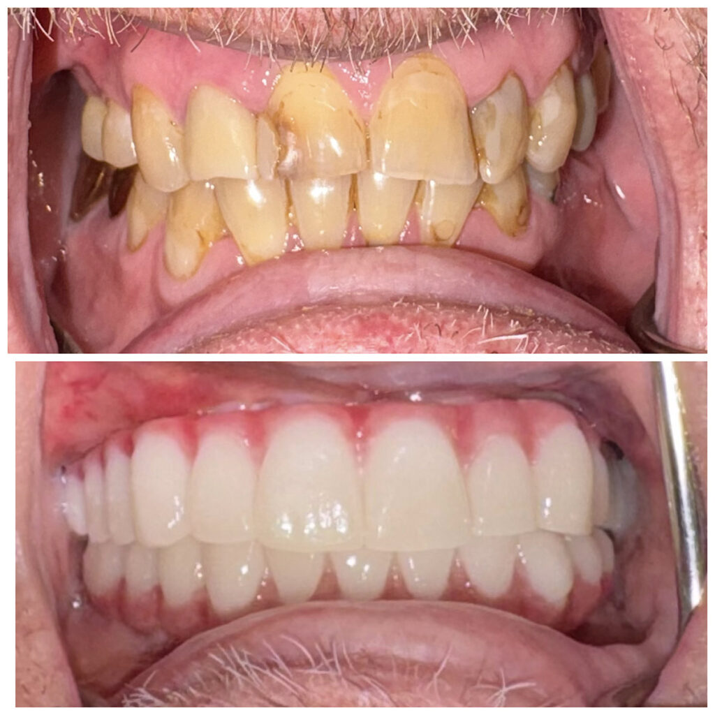 Before and After Teeth Photo - Smilodon Dental + Implants - Nashville