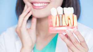 Dental Implants